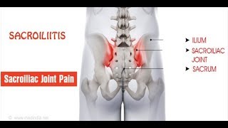 सैक्रोइलिइटिस  Sacroiliitis PAIN  कारण लक्षण और निदान एवं लाभदायक योग [upl. by Nalra]