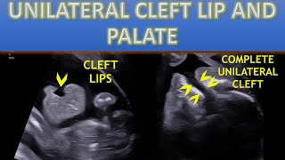 FETAL CLEFT LIP AND PALATE in a 23 WEEKER  ANOMALY SCAN [upl. by Herrick753]