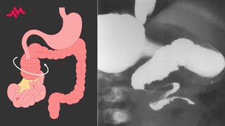 Child with Abdominal Distention and Vomiting  Case Report [upl. by Raddy]