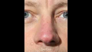 Couperose of the Nose Intense Pulsed Light IPL Treatment [upl. by Jilleen941]