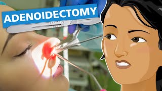 Adenoidectomy [upl. by Ettenhoj115]