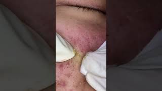 Big Cystic Acne Blackheads Extraction Blackheads amp Milia Whiteheads Removal Pimple Popping shorts [upl. by Tezile]