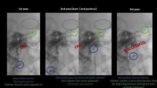 Stroke  Carotid quotTquot 3 passes [upl. by Enyrehtac969]