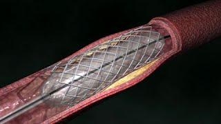 Angioplastia de arteria coronaria Vía radial [upl. by Aurelius]