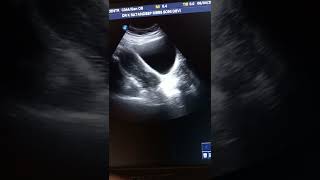 Nabothian cyst ultrasound [upl. by Magree]