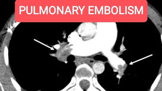 Pulmonary Embolism with multiple hepatic metastasis  CT Chest with Whole Abdomen [upl. by Pember]