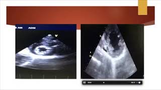 INTERPRETATION OF ECHOCARDIOGRAPHY REPORT by Dr Amarja Nagre [upl. by Akcinat819]