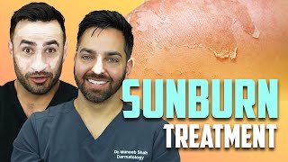 SUNBURN  How To Treat a Sunburn like a Dermatologist [upl. by Christmann69]