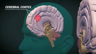 What is glioblastoma [upl. by Ohs]