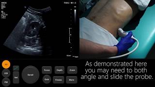 Ultrasound Tutorial Kidney amp Bladder  Urinary Tract  Radiology Nation [upl. by Yrocal]