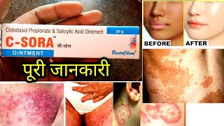 CSORA Ointment uses in hindi  c sora ointment uses in hindi  medisalic ointment  lobate s cream [upl. by Fitts]