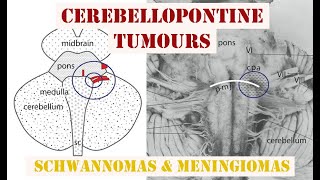 Cerebellopontine Tumours  Schwannomas amp Meningiomas [upl. by Rednal256]