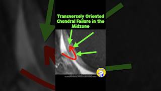 Fig 5A16 Transverse Chondral Flap Lesions in Midzone [upl. by Landan]