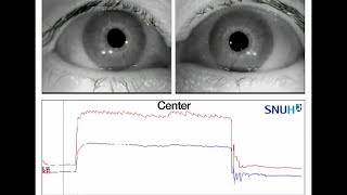 Bilateral Internuclear Ophthalmoplegia Observed in Anti–GQ1b Antibody Syndrome [upl. by Bigford]