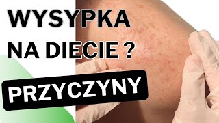 Czy wysypka podczas diety niskowęglowodanowej lub ketogenicznej to powszechna sprawa [upl. by Adil]