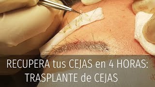 RECUPERA tus CEJAS en 4 HORAS TRASPLANTE de CEJAS [upl. by Kobi]