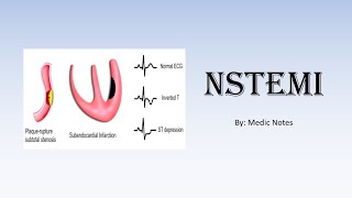 NSTEMI nonST elevation myocardial infarction  investigations management [upl. by Amesari]