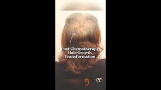 Hair Growth Post Chemotherapy [upl. by Ylram]