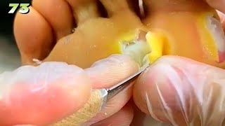 73Clean up large lesions on the soles of the feet [upl. by Akihsat914]