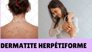 Dermatite Herpétiforme [upl. by Ainegue]