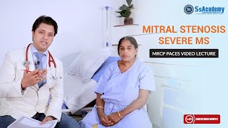 MRCP PACES Clinical Case  Cardiology  Severe Mitral Stenosis MS [upl. by Litta]