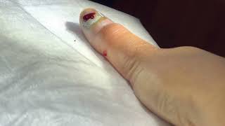 Trephination of a Fingernail Subungual Hematoma [upl. by Schilit882]