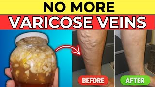 Transform Your Legs Discover the 27 Superfoods That Banish Varicose Veins for Good [upl. by Hachman]