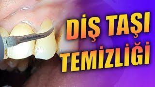 Diş Taşı Temizliği ve Kök Yüzeyi Düzleştirmesi [upl. by Tadd]