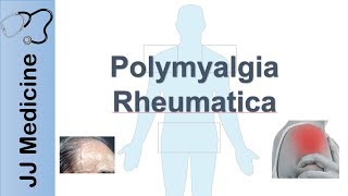 Polymyalgia Rheumatica  Signs amp Symptoms Diagnosis and Treatment [upl. by Eicyac517]