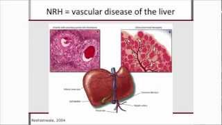 Nonviral Hepatitis and hepatoxicity presented by Patrick Ingiliz [upl. by Kippy]