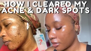 HOW I CLEARED MY ACNE BREAKOUTS AND DARK SPOTS NO TRETINOIN  iJay Amadi [upl. by Philbo]