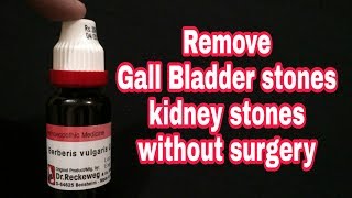 Berberis vulgaris review Remove Gall bladder and kidney stones without surgery [upl. by Eudo82]