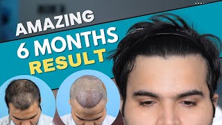 Hair Transplant in Kochi  Best Results amp Cost of Hair Transplant in Kochi [upl. by Aneehsar]