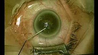 corneal glass injury [upl. by Heppman]