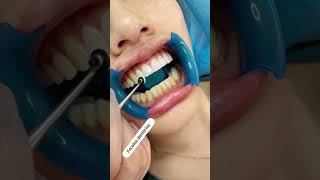 💥Facetas Dentárias Transforme Seu Sorriso em um Show de Beleza‼️💎🦷✨facetasderesina dentes [upl. by Leisam934]