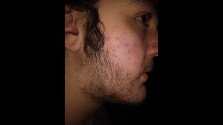 5 Minoxidil Beard Journey Before and After 40 Weeks [upl. by Marx425]