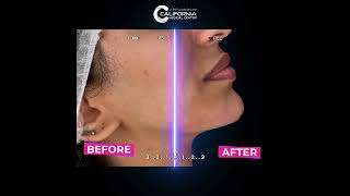 Transform your profile with jawline contouring [upl. by Rebmak]