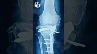 Intraarticular osteotomy [upl. by Bently]