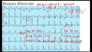Ejemplo Bloqueo Bifascicular [upl. by Sybil177]