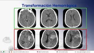 IMAGENES EN STROKE PARA MEDICOS GENERALISTAS 14 min [upl. by Socin]