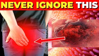 Critical Colon Cancer Symptoms You Should Never Ignore [upl. by Notgnimer]