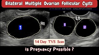 TVS Ultrasound  Bilateral multiple Ovarian Follicular Cysts [upl. by Adieno]