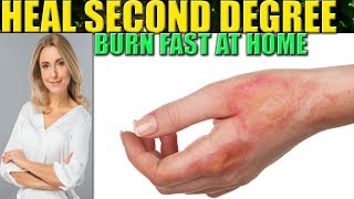 How To Heal A Burn Fast 2nd Degree Burns Wound Care Home Remedies [upl. by Meisel]