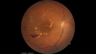 Treatment for Retinal Vein Occlusion [upl. by Anayek504]