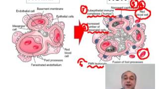 Acute Glomerulonephritis [upl. by Ruhtracm]