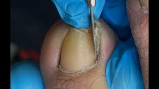 Huge ingrown toenail removal [upl. by Chaffinch]