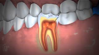 Treatment of Abscessed Teeth [upl. by Soalokin]