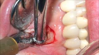 Apicoectomy after Biofilling with OrthoMTA [upl. by Eidas]