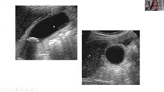 Echographie de la vésicule biliaire [upl. by Liahcim469]