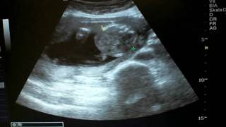 Ultraschall in der 19 SSW Its a Boy [upl. by Kwabena]